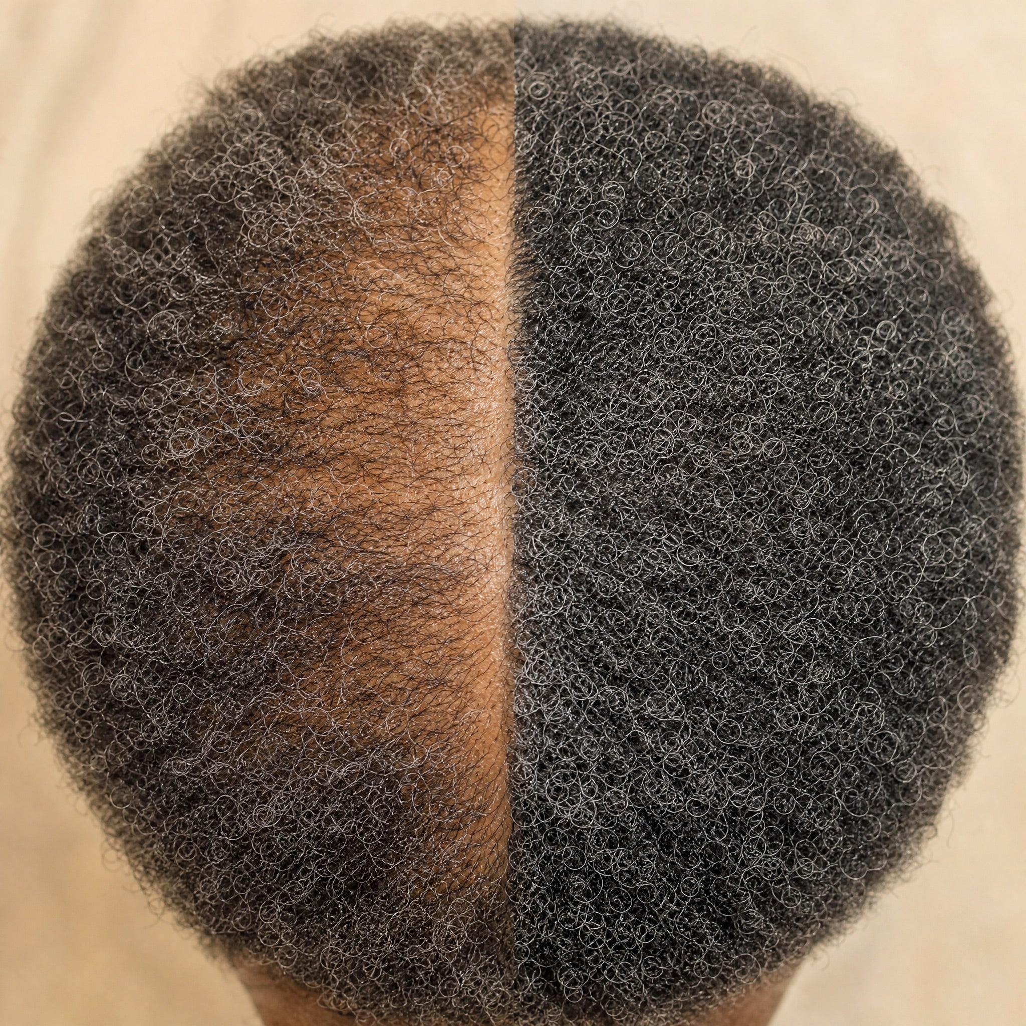 Calvae before and after result